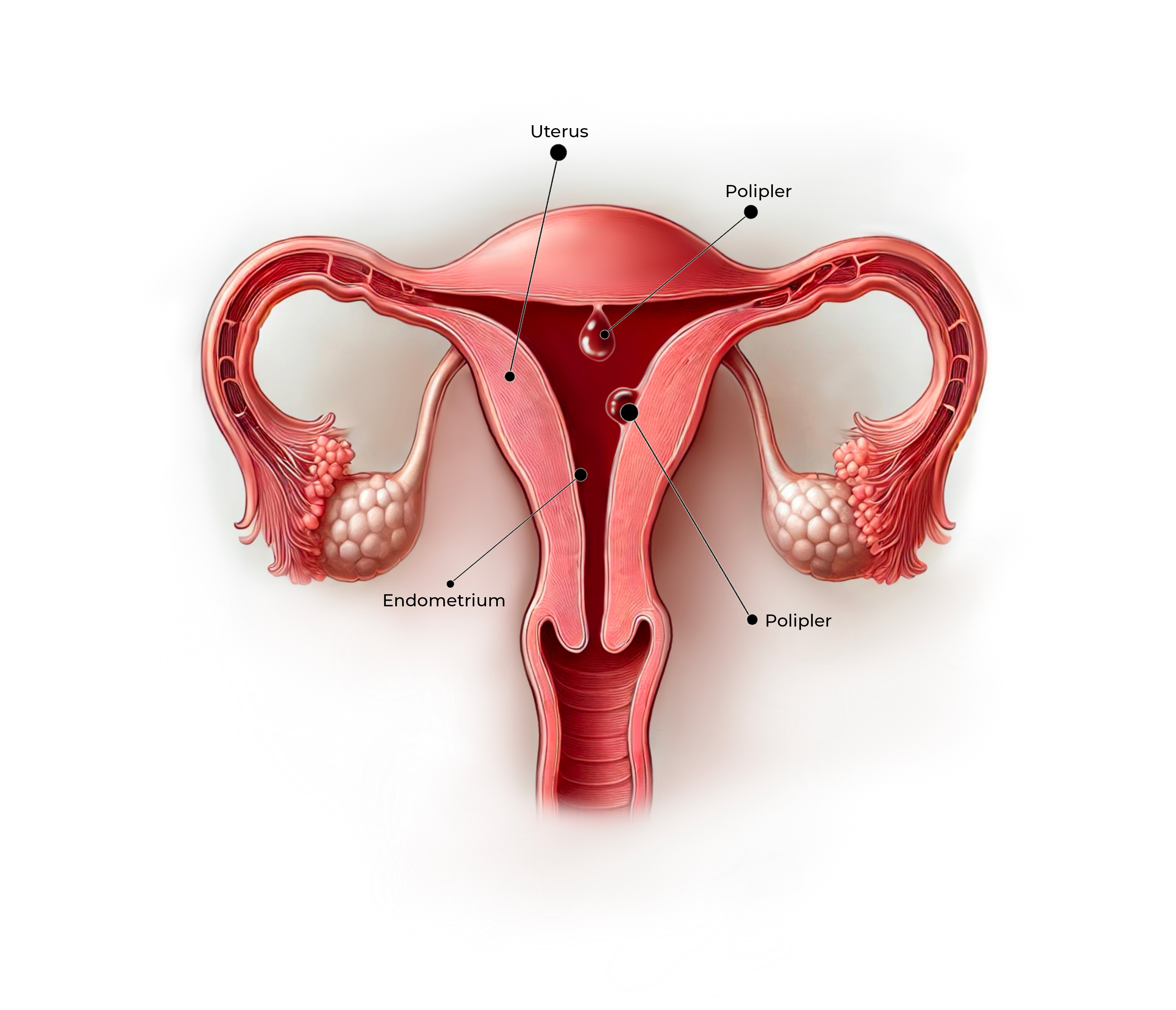 Endometrial Polipler