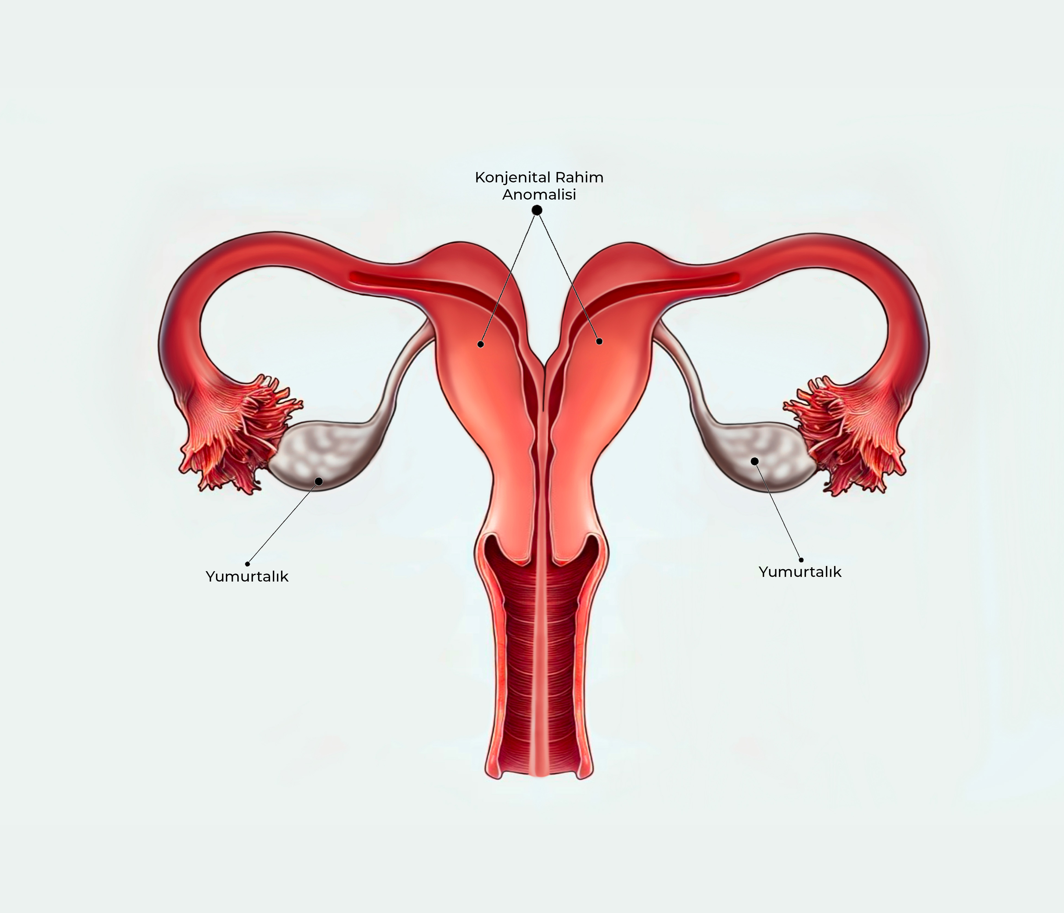 Konjenital Rahim Anomalileri