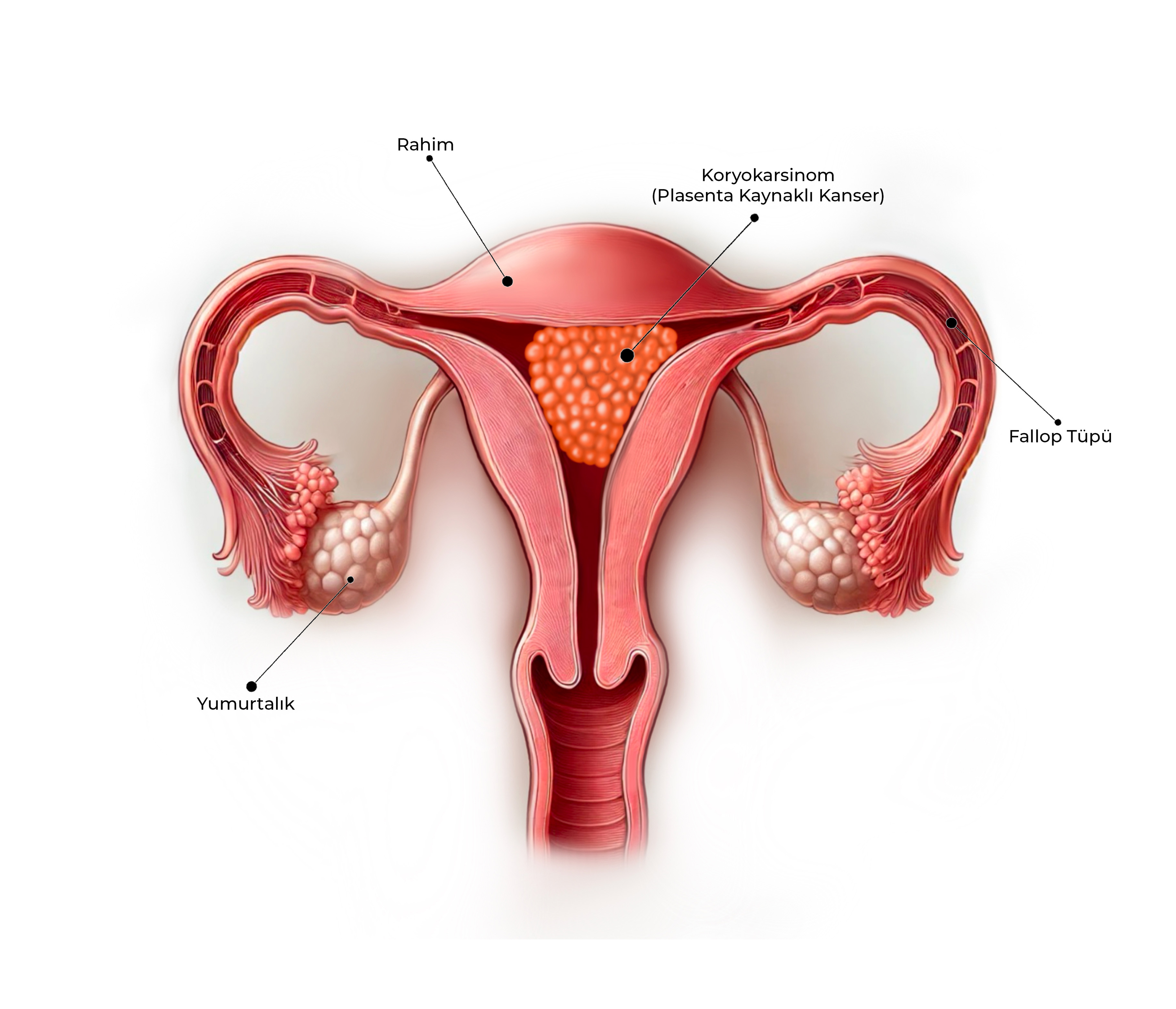 Koryokarsinom (Plasenta Kaynaklı Kanser)