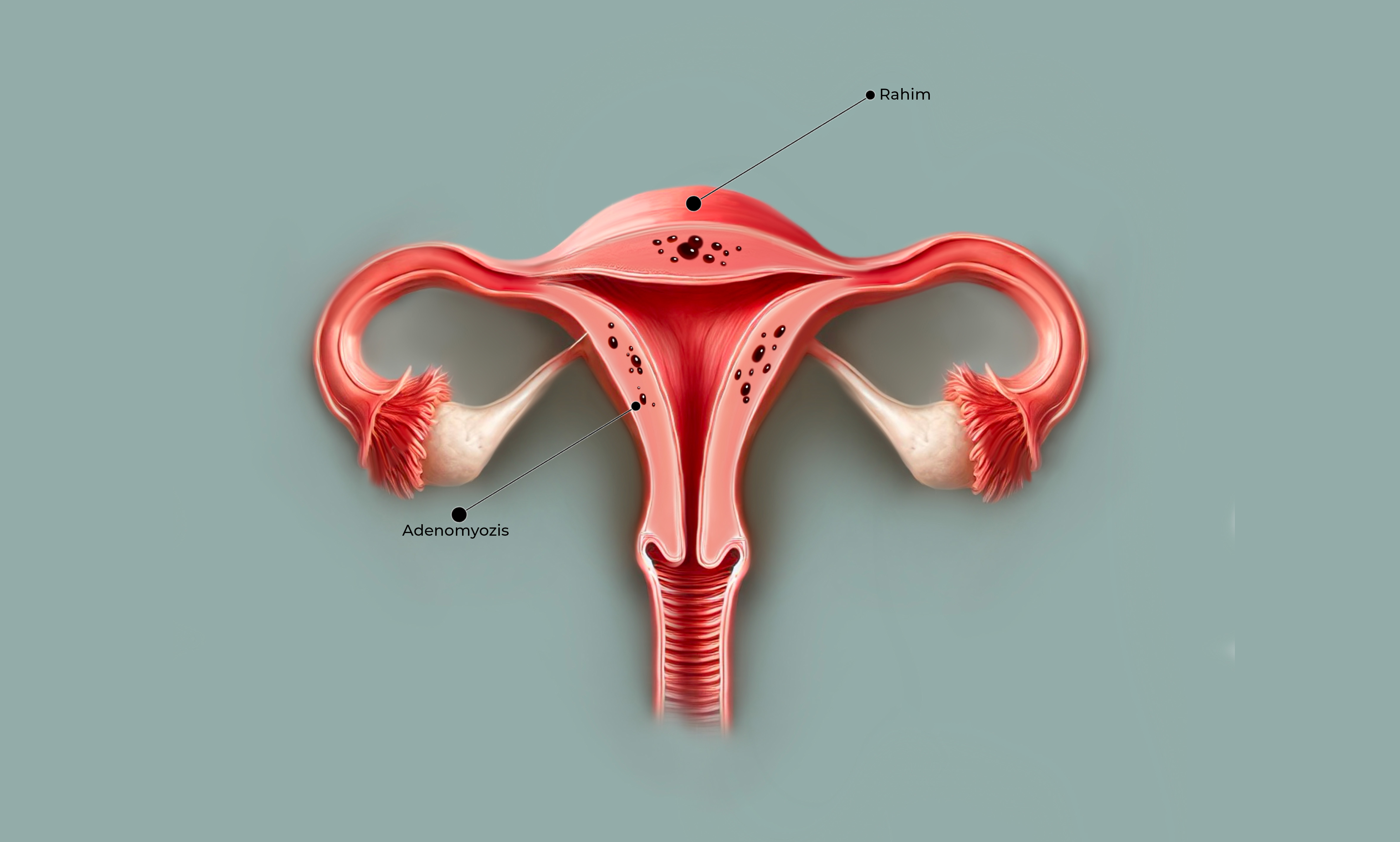 Adenomyozis Görseli