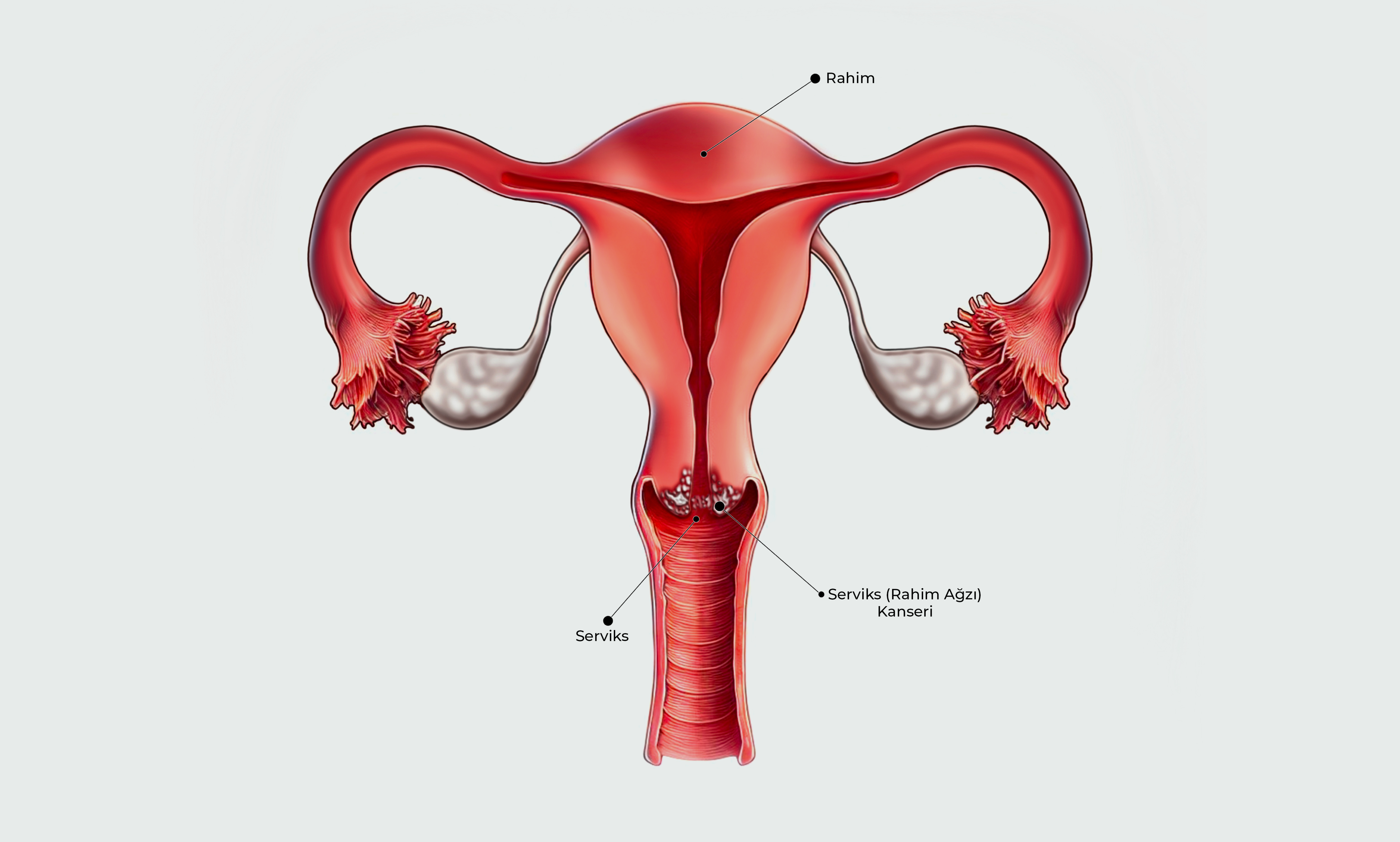 Serviks (Rahim Ağzı) Kanseri Görseli