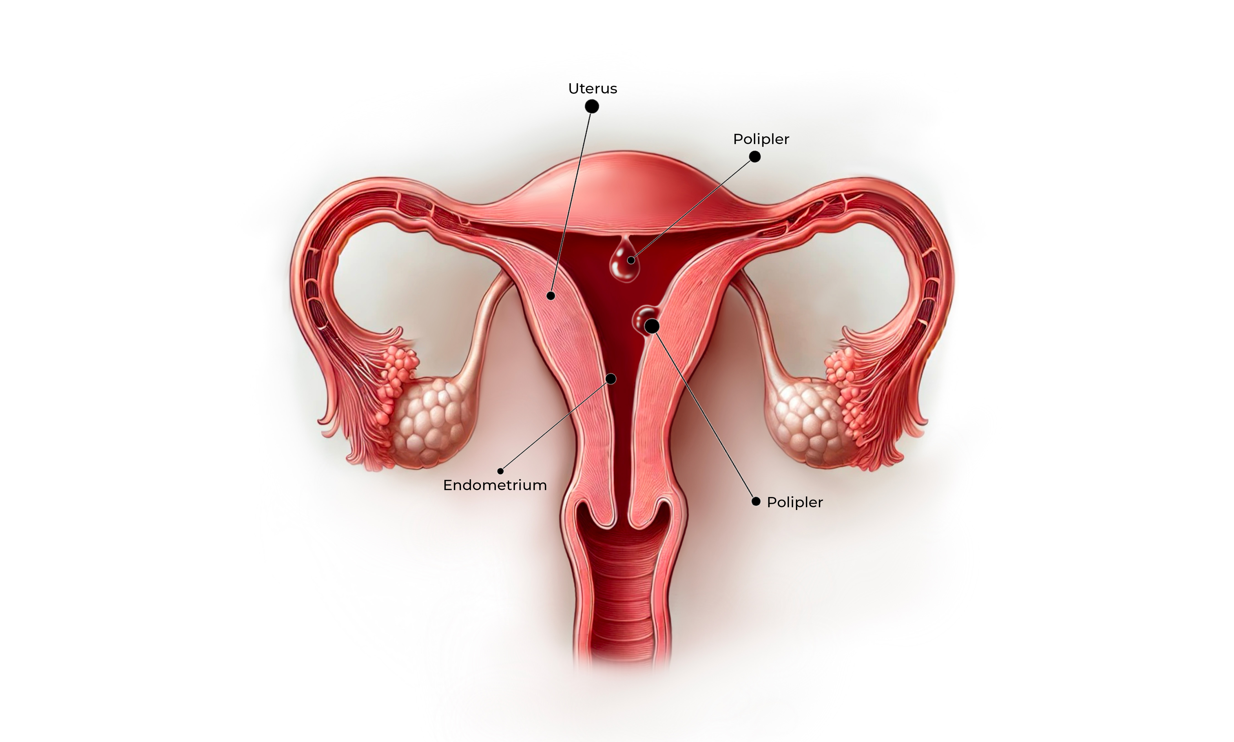 words.endometrial_polipler_gorsel