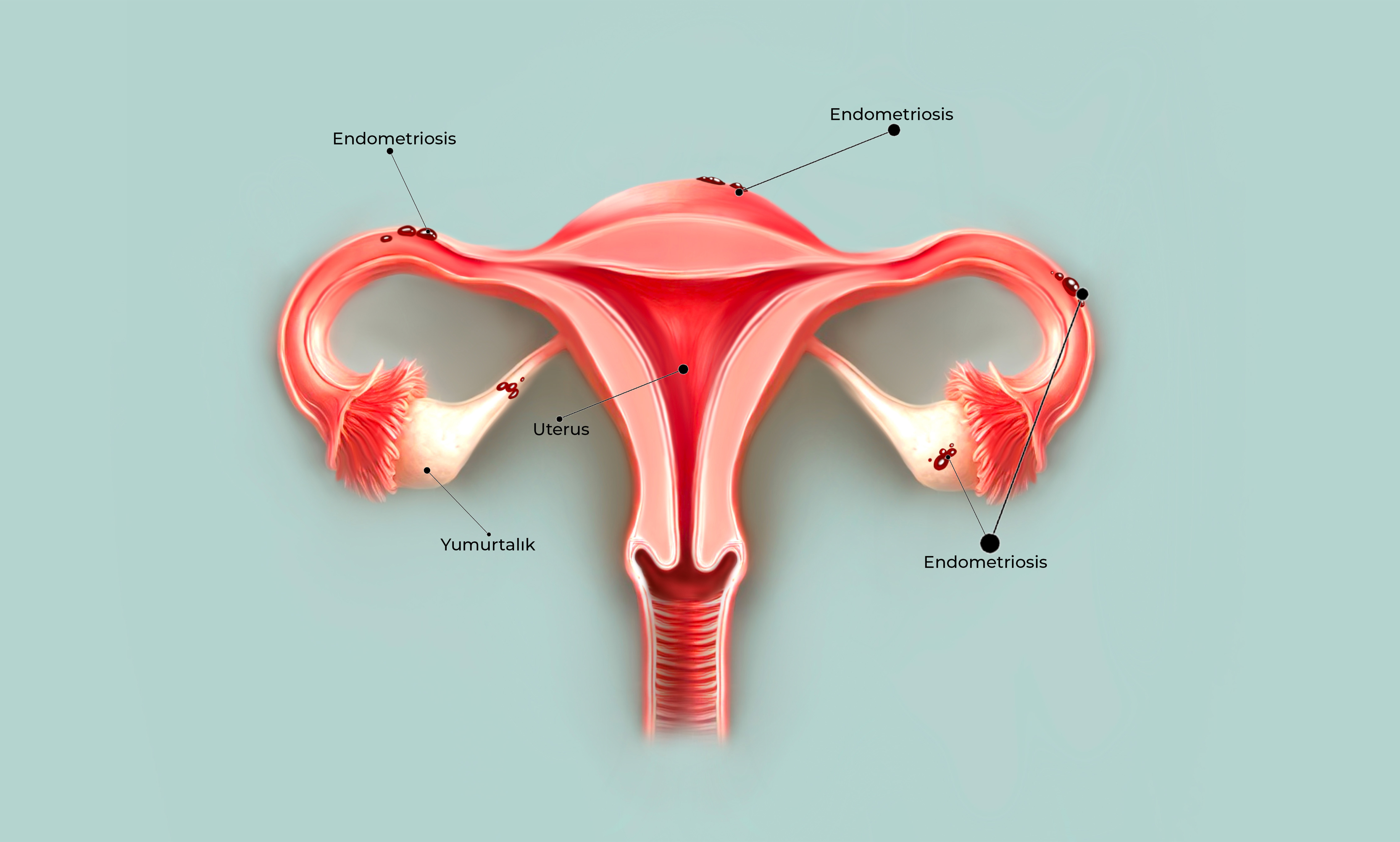 Endometriosis