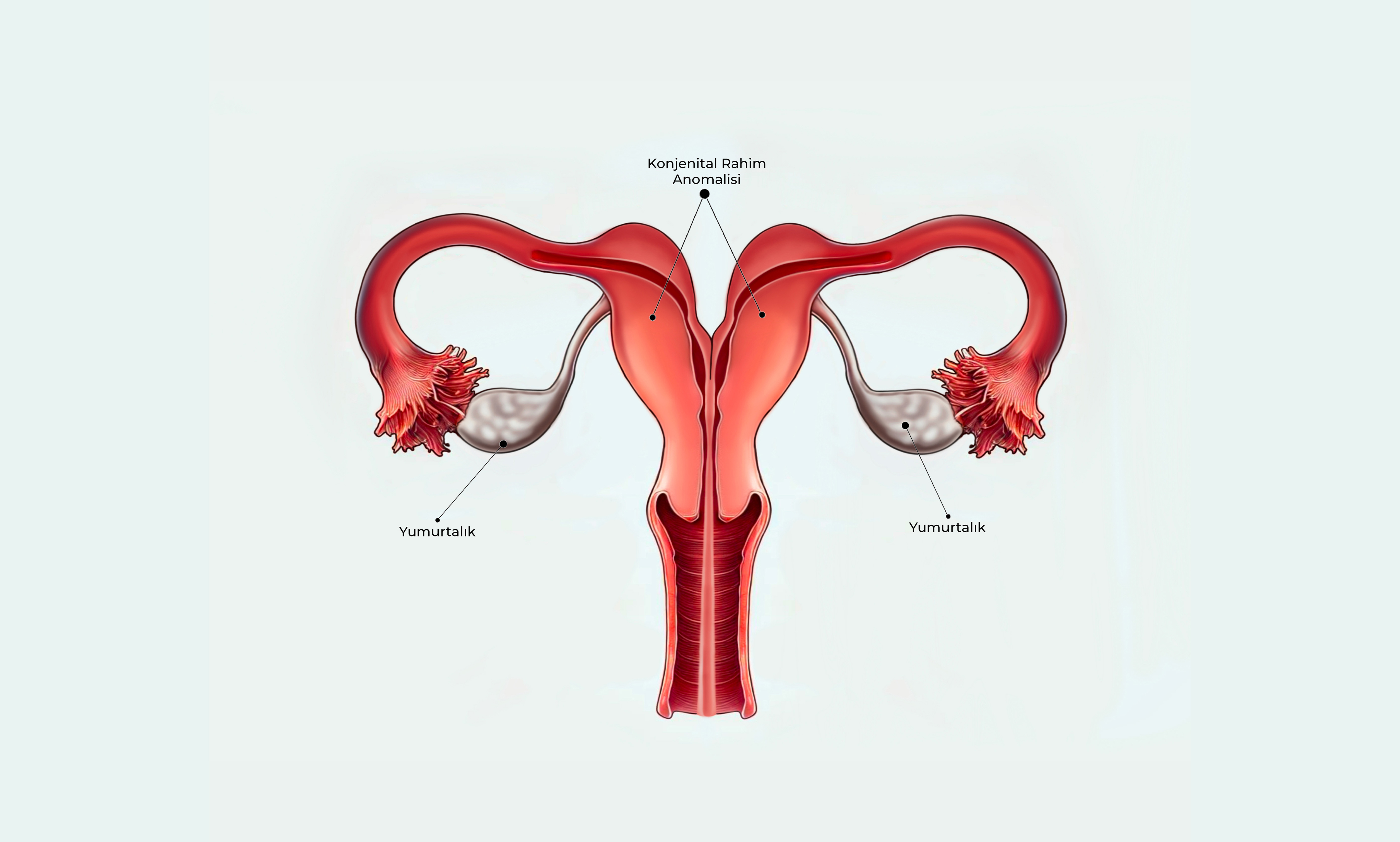 Konjenital Rahim Anomalileri Görseli