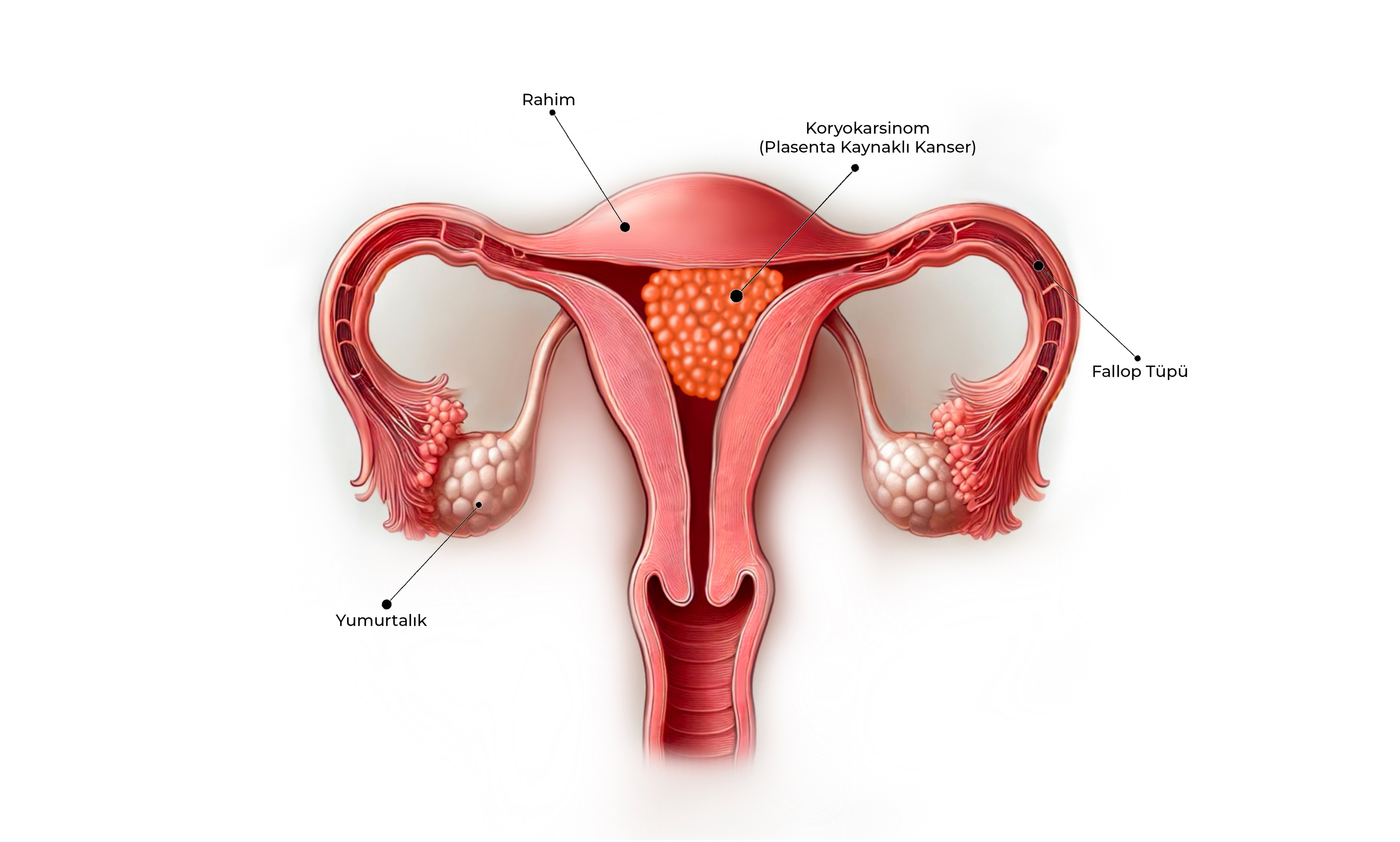 Koryokarsinom (Plasenta Kaynaklı Kanser) Görseli