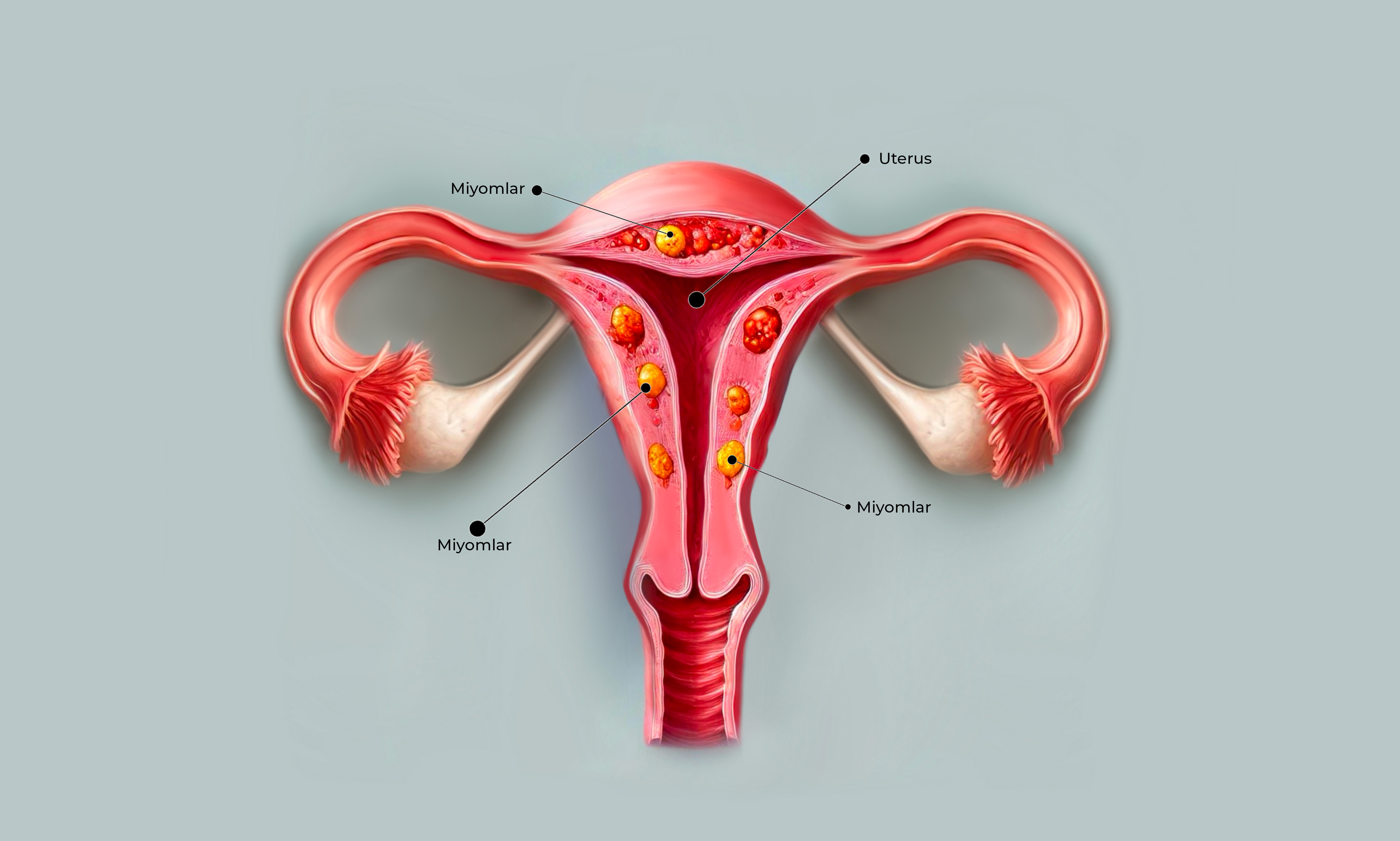 words.myomas_(uterine_fibroids)_image