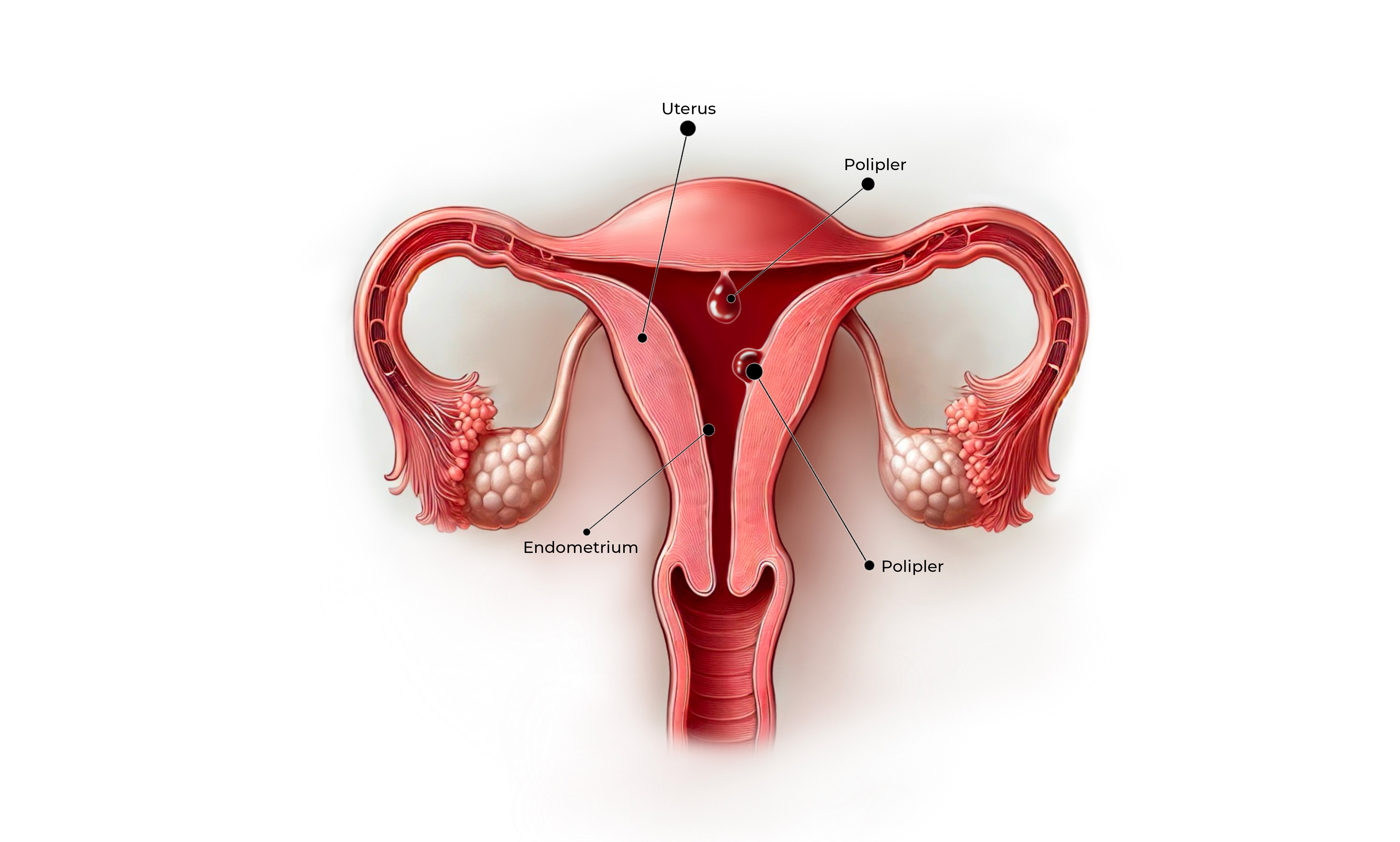 Rahimde Polip Görseli