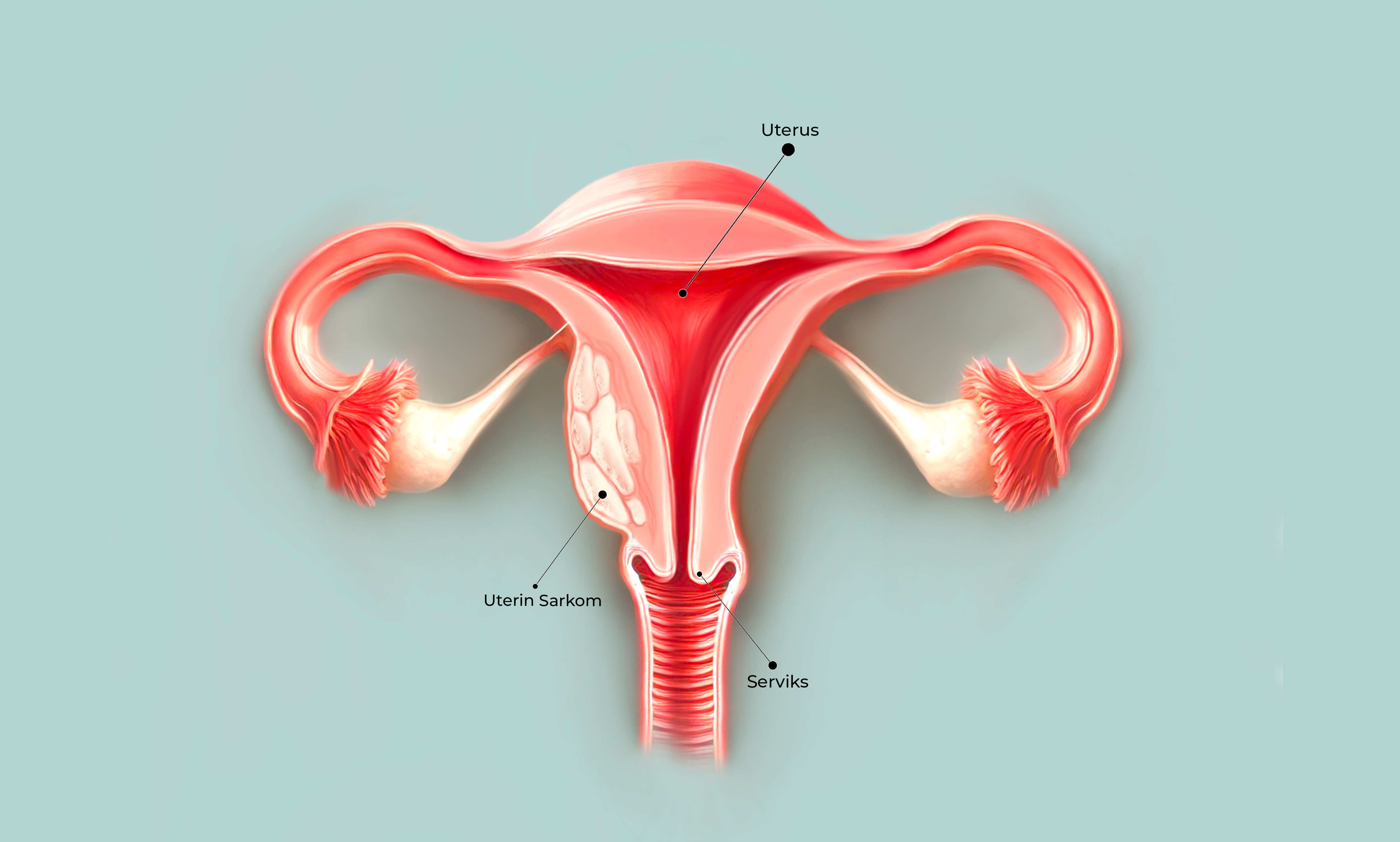 Uterin Sarkomlar Görseli